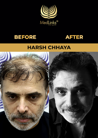 Gulshan Grover hair transplant before and after